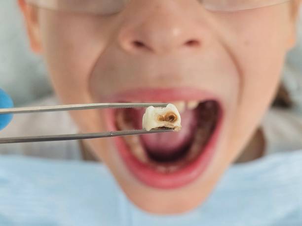 Best Emergency Dental Care for Broken or Chipped Teeth in Stepney, CT